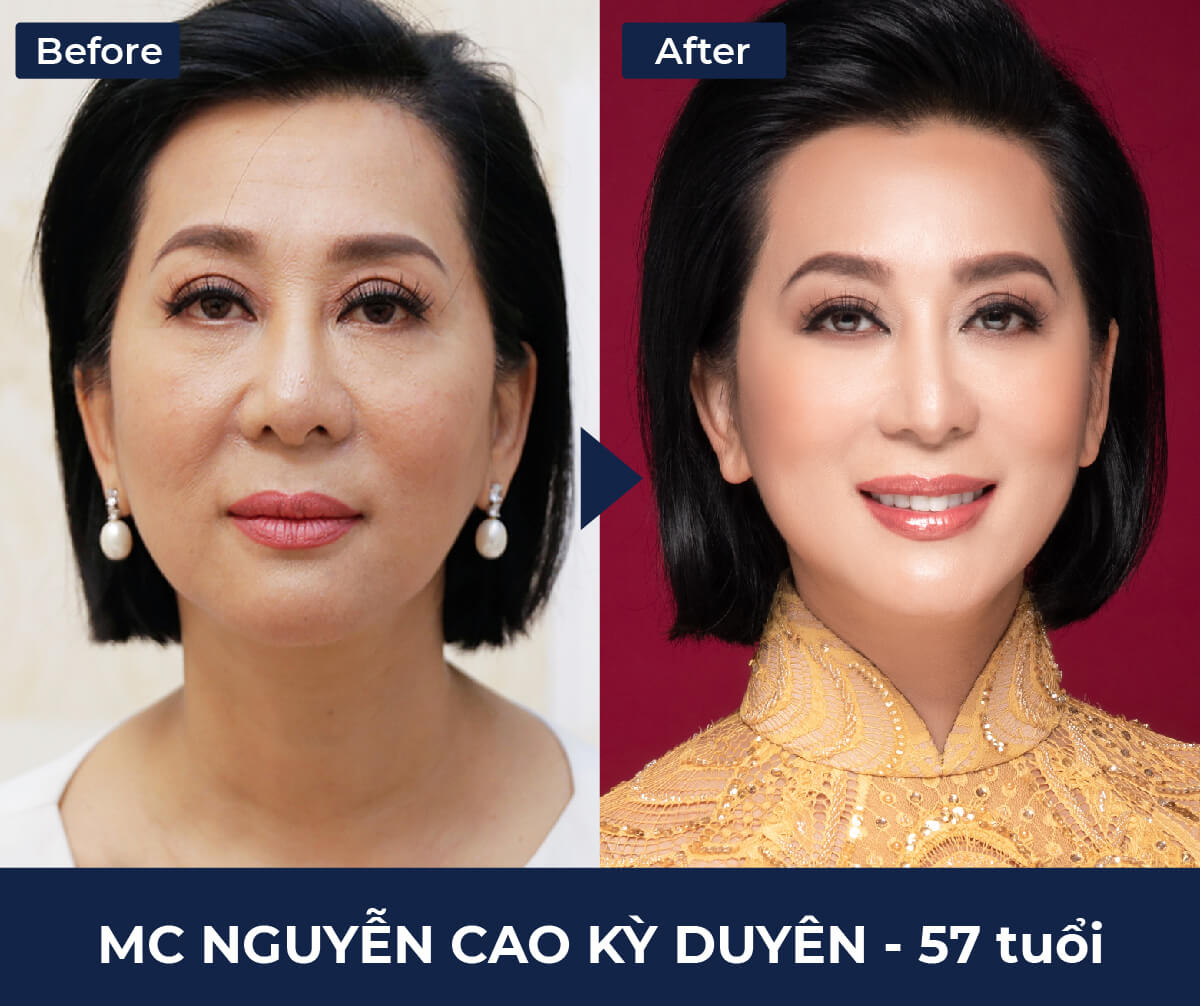 MC Nguyễn Cao Kỳ Duyên như trẻ ra vài tuổi sau khi thực hiện căng chỉ không tiêu Hoa Kỳ