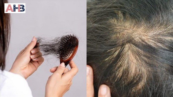 Những người hay bị rụng tóc nhiều nên áp dụng phương pháp tiêm Meso Hair