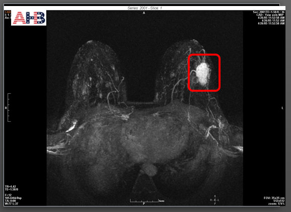 Tầm soát ung thư vú nhờ kỹ thuật chẩn đoán hình ảnh MRI