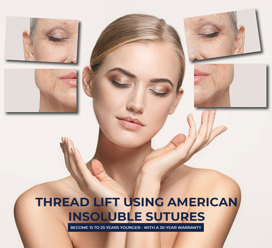 Thread Lift Using American Insoluble Sutures