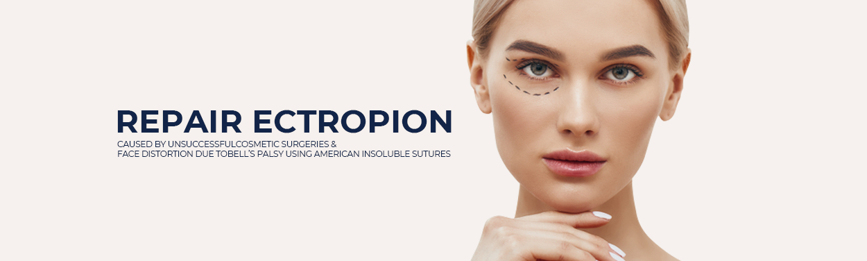 Repair Ectropion Caused By Unsuccessful Cosmetic  Surgeries