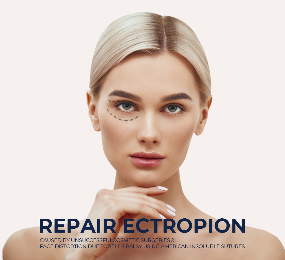 Repair Ectropion Caused By Unsuccessful Cosmetic  Surgeries