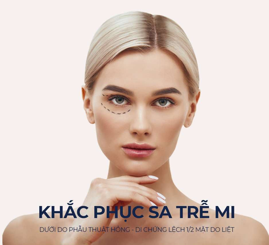 Khắc Phục Sa Trễ Mi Dưới Do Phẫu Thuật Hỏng